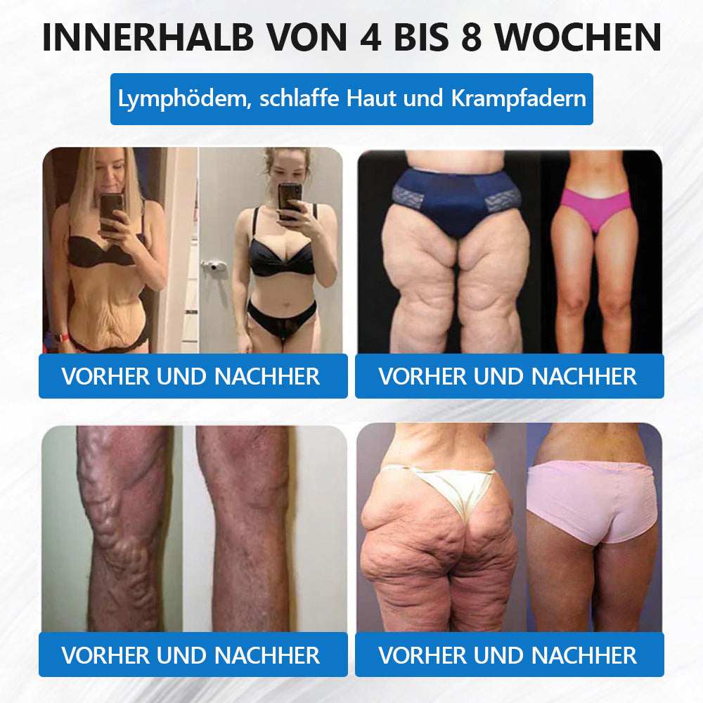 【👩‍⚕️Letzter Tag Aktion – 60 % RABATT】💕𝐋𝑬𝘙𝐶𝘌𝘼® 𝐒𝐌𝐆𝐓-𝐆𝐋𝐏-𝟏 𝐓𝐢𝐫𝐳𝐞𝐩𝐚𝐭𝐢𝐝𝐞 & 𝐊𝐨𝐥𝐥𝐚𝐠𝐞𝐧-𝐍𝐚𝐧𝐨-𝐌𝐢𝐤𝐫𝐨𝐧𝐚𝐝𝐞𝐥-𝐏𝐟𝐥𝐚𝐬𝐭𝐞𝐫👑