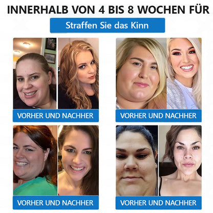 【👩‍⚕️Letzter Tag Aktion – 60 % RABATT】🌟𝐋𝑬𝘙𝐶𝘌𝘼® 𝐒𝐌𝐆𝐓-𝐆𝐋𝐏-𝟏 𝐓𝐢𝐫𝐳𝐞𝐩𝐚𝐭𝐢𝐝𝐞 & 𝐊𝐨𝐥𝐥𝐚𝐠𝐞𝐧-𝐍𝐚𝐧𝐨-𝐌𝐢𝐤𝐫𝐨𝐧𝐚𝐝𝐞𝐥-𝐏𝐟𝐥𝐚𝐬𝐭𝐞𝐫👑